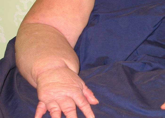 lymphedema